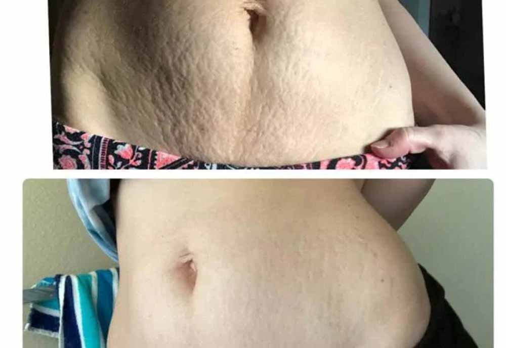 जिद्दी स्ट्रेच मार्क्स से छुटकारा पाएँ – वो भी घर पर आसानी से