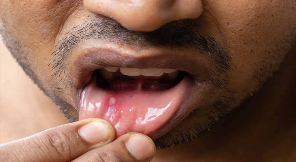 गुटखा, तंबाकू और सिगरेट का जानलेवा असर, MP में माउथ कैंसर के मामले 40% बढ़े; सामने आए चौंकाने वाले आंकड़े