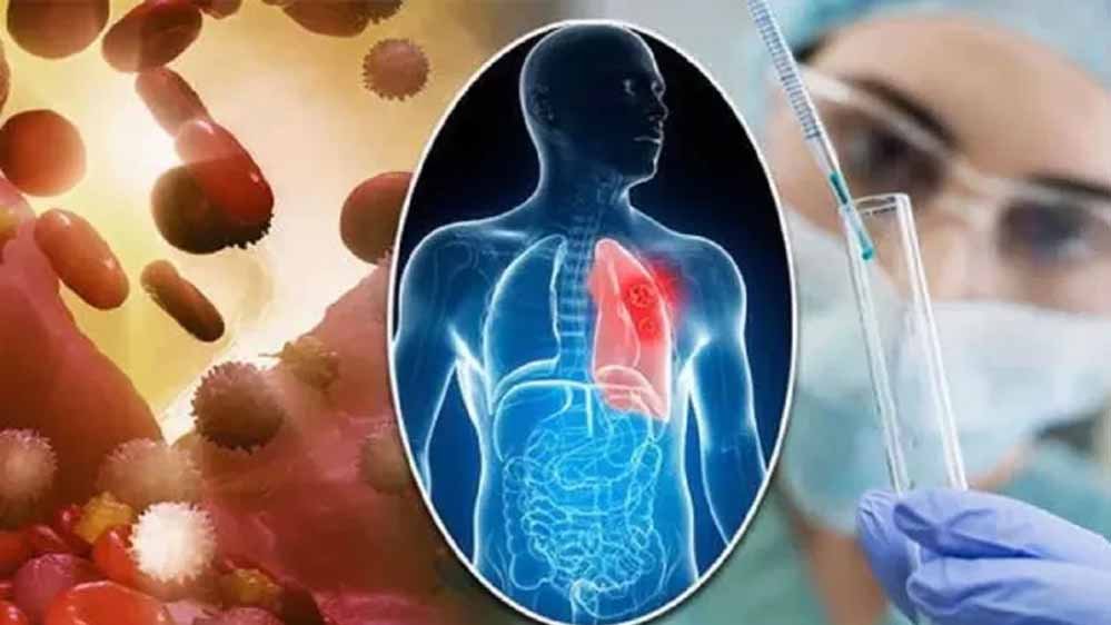 कैंसर उपचार में बड़ी उम्मीद, नई तकनीक से ट्यूमर को निशाना बनाना होगा आसान; स्वस्थ अंगों को बचाने में मिलेगी मदद